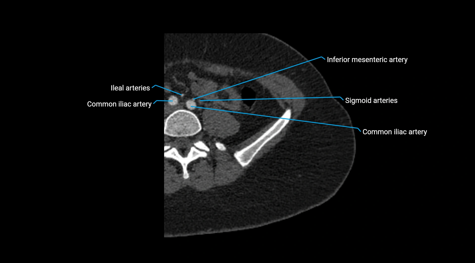 CTA lower limb cross sectional anatomy labelled image _7.webp